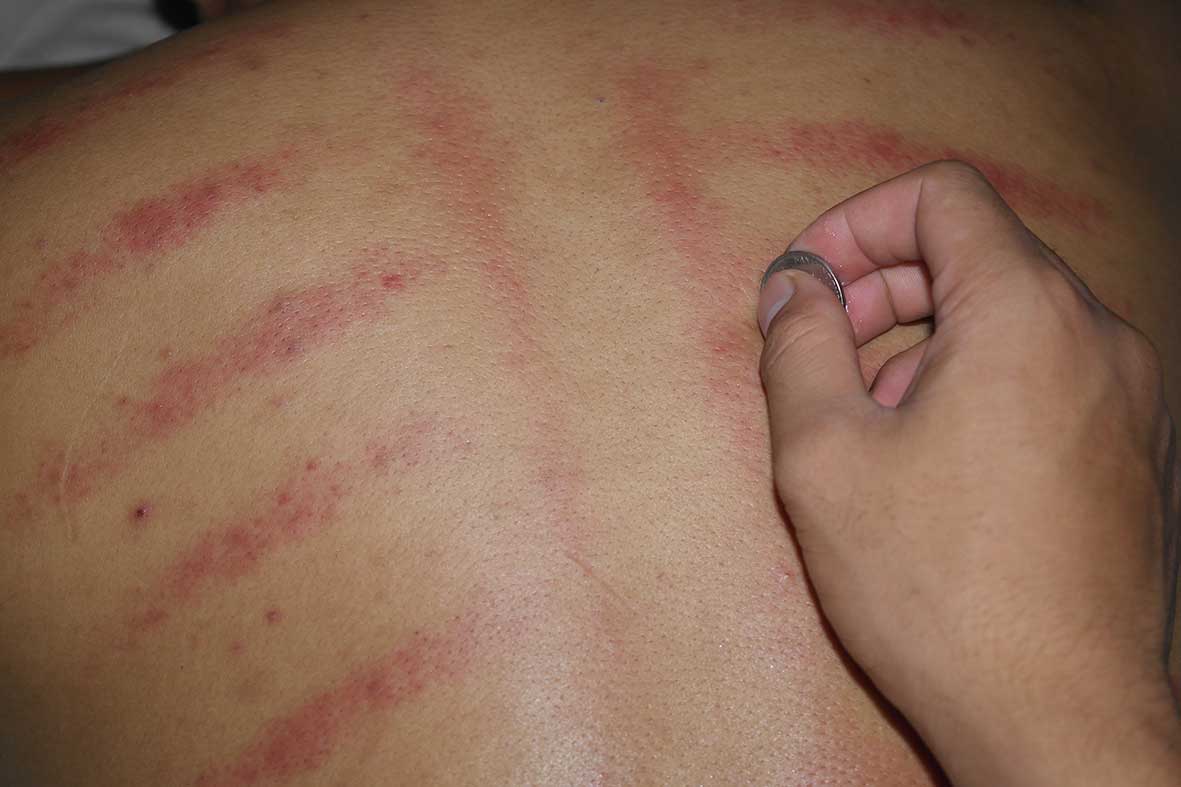 Kerokan Untuk Mengobati Masuk Angin